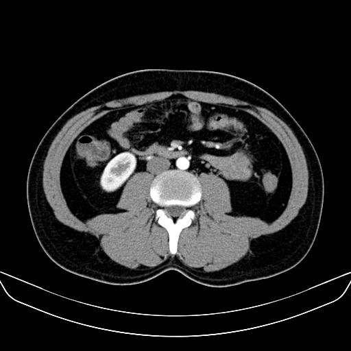 File:Bilateral accessory renal arteries with mild pelvi-ureteric junction (PUJ) obstruction (Radiopaedia 66357-75596 A 33).jpg