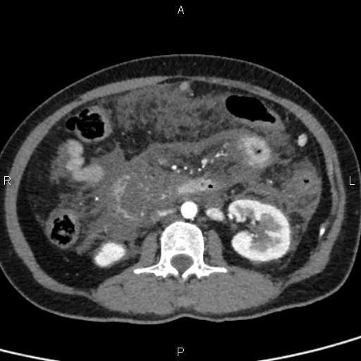 Bilateral adrenal gland hyperenhancement in pancreatitis (Radiopaedia 86642-102753 B 67).jpg