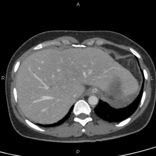 Bilateral adrenal gland hyperenhancement in pancreatitis (Radiopaedia 86642-102753 E 15).jpg