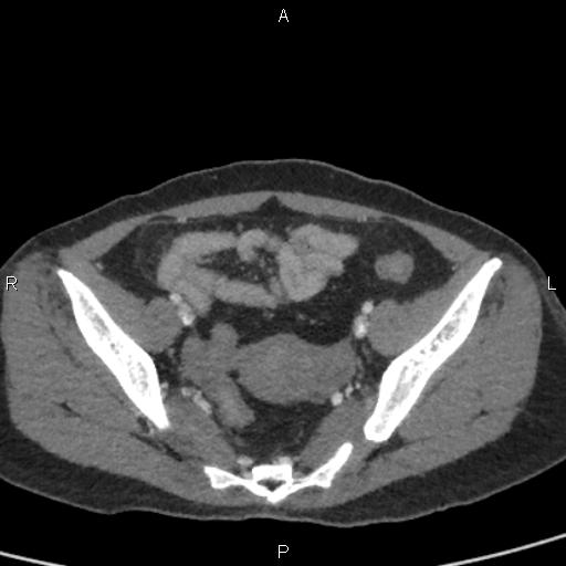 Bilateral adrenal gland hyperenhancement in pancreatitis (Radiopaedia 86642-102753 E 93).jpg