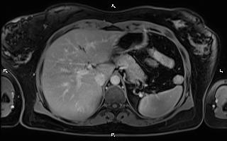 File:Bilateral adrenal myelolipoma (Radiopaedia 63058-71537 H 27).jpg