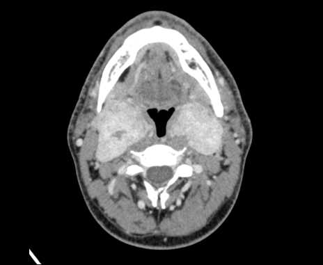 File:Bilateral carotid body tumors (Radiopaedia 61841-69870 Axial Post contrast 42).jpg