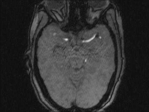 Bilateral carotid body tumors and right glomus jugulare tumor (Radiopaedia 20024-20060 Axial MRA 337).jpg