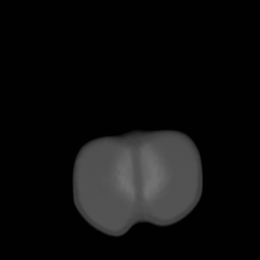 File:Bilateral cephalohematomas and subdural hematomas (Radiopaedia 26778-26929 Axial bone window 31).jpg
