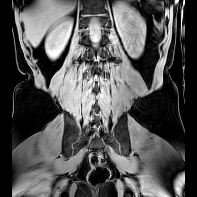 Bilateral conjoined nerve roots at different levels (Radiopaedia 73312-84063 Coronal WE 41).jpg