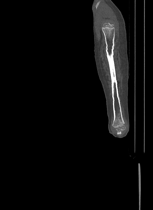 Bilateral fibular hemimelia type II (Radiopaedia 69581-79491 Sagittal bone window 71).jpg