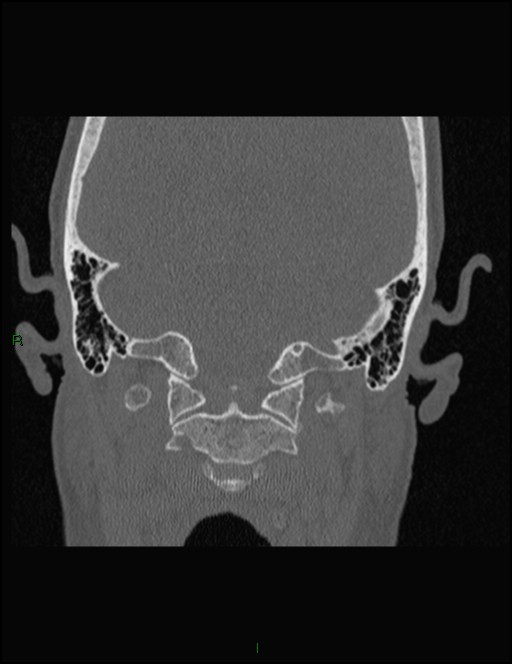 Bilateral frontal mucoceles (Radiopaedia 82352-96454 Coronal 353).jpg