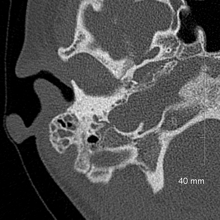 Bilateral grommets (Radiopaedia 47710-52404 Axial bone window 18).jpg