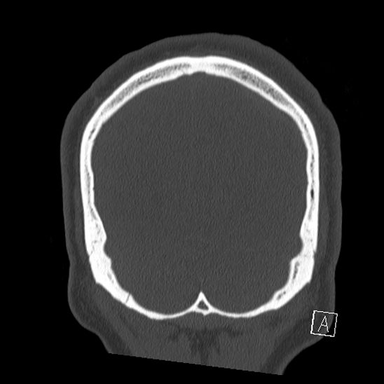 Bilateral occipital condyle fracture (type 2) (Radiopaedia 87675-104089 Coronal bone window 130).jpg