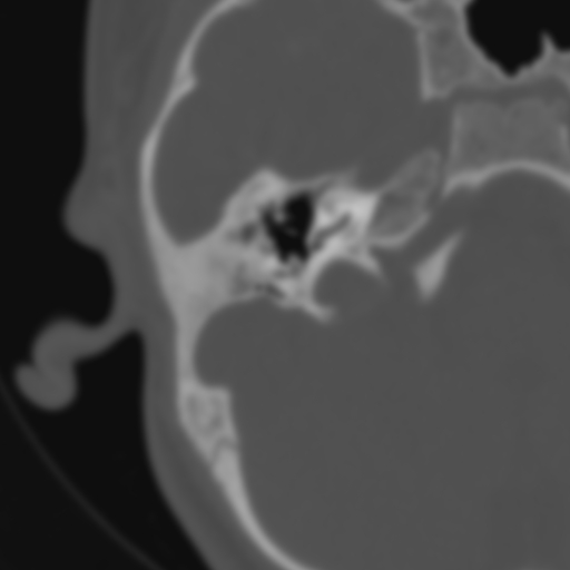 Bilateral otosclerosis (Radiopaedia 57237-64157 B 52).jpg