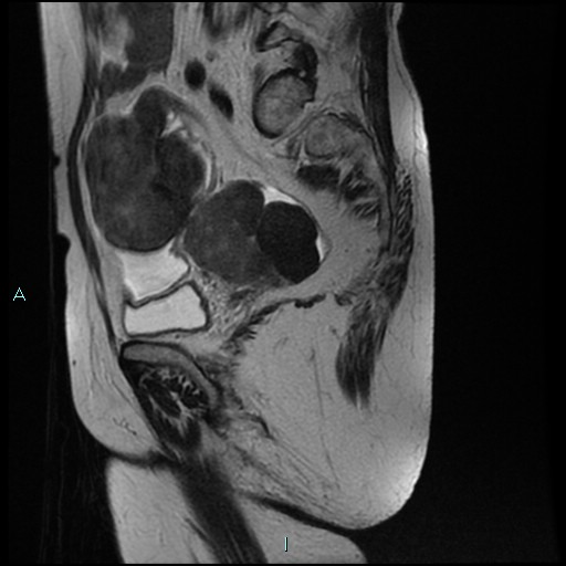 File:Bilateral ovarian fibroma (Radiopaedia 44568-48293 Sagittal T2 12).jpg