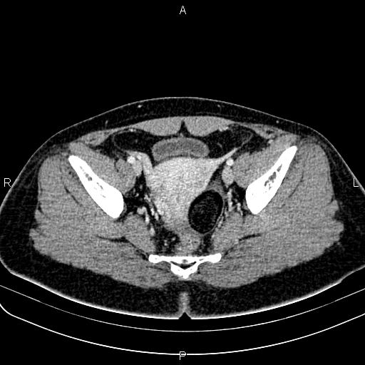 File:Bilateral ovarian teratoma (Radiopaedia 83131-97503 Axial With contrast 46).jpg