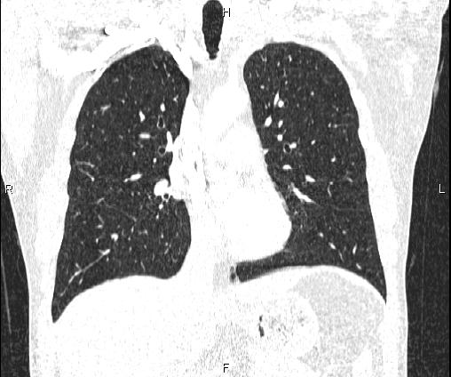 File:Bilateral pulmonary AVM (Radiopaedia 83134-97505 Coronal lung window 40).jpg