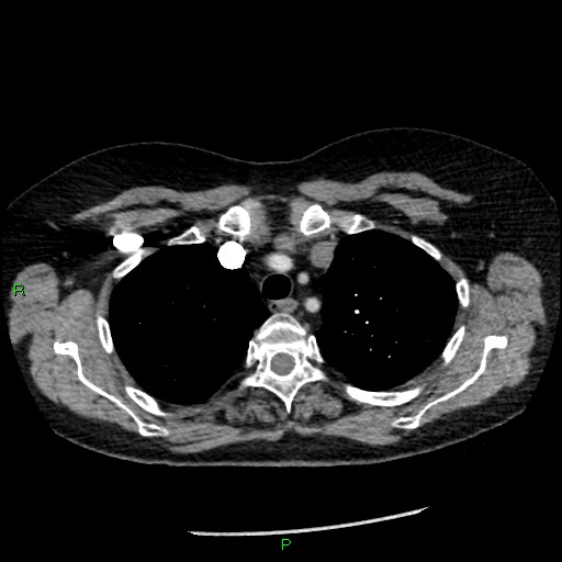 Bilateral pulmonary emboli (Radiopaedia 32700-33669 Axial C+ CTPA 23).jpg