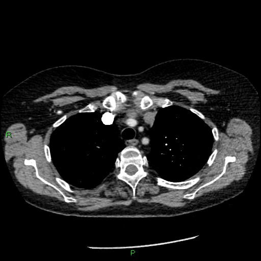 Bilateral pulmonary emboli (Radiopaedia 32700-33669 Axial C+ CTPA 24).jpg
