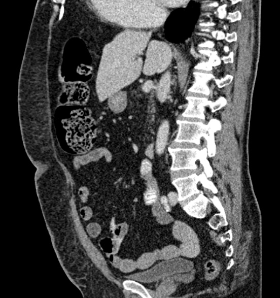 Bilateral rectus sheath hematomas (Radiopaedia 50778-56252 B 38).jpg