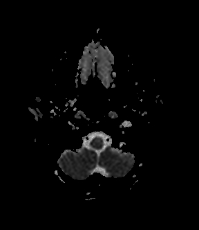 File:Bilateral thalamic glioma (Radiopaedia 65852-75009 Axial ADC 2).jpg