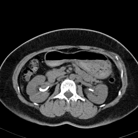 Bilateral ureteric stents (Radiopaedia 48795-53825 Axial non-contrast 22).jpg