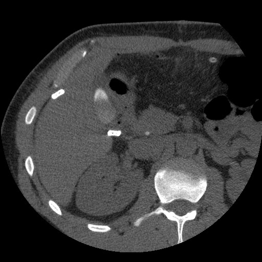 File:Bile leak from liver traumatic laceration (Radiopaedia 63463-72077 Axial Biliscopin 53).jpg
