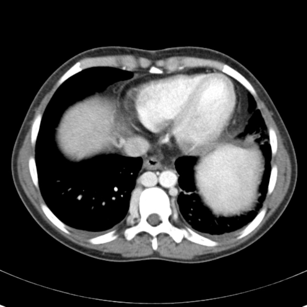 Biliary necrosis - liver transplant (Radiopaedia 21876-21846 B 5).jpg