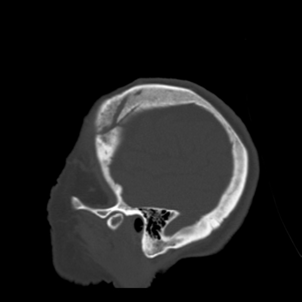 Biparietal osteodystrophy (Radiopaedia 46109-50463 Sagittal bone window 16).jpg