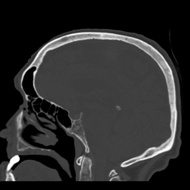 Biparietal osteodystrophy (Radiopaedia 46109-50463 Sagittal bone window 52).jpg