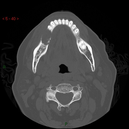 Bisphosphonate-related osteonecrosis of the jaw (Radiopaedia 54147-60329 Axial bone window 34).jpg