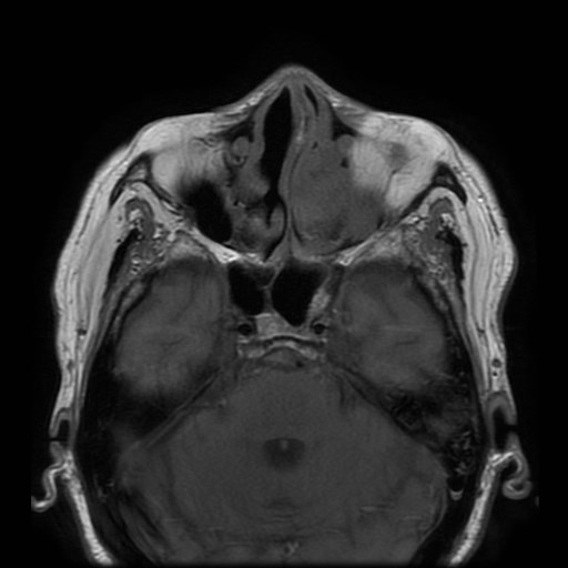 Bisphosphonate-related osteonecrosis of the maxilla (Radiopaedia 51367-57101 Axial T1 35).jpg