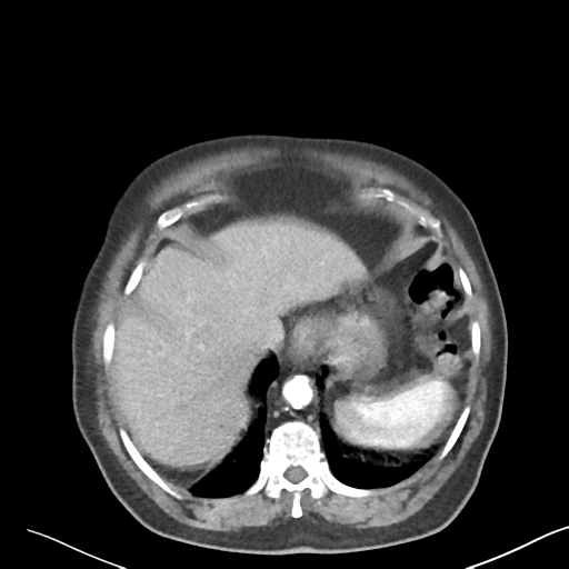 File:Bladder papillary urothelial carcinoma (Radiopaedia 48119-52951 A 1).png