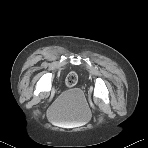 File:Bladder papillary urothelial carcinoma (Radiopaedia 48119-52951 Axial C+ delayed 51).png