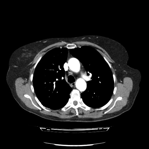 File:Bladder tumor detected on trauma CT (Radiopaedia 51809-57609 A 38).jpg