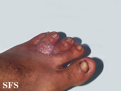 Blastomycosis South American (Dermatology Atlas 4).jpg