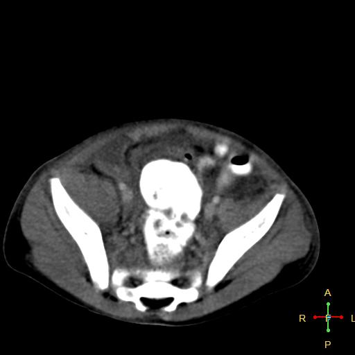Blunt abdominal trauma (Radiopaedia 24780-25044 B 40).jpg