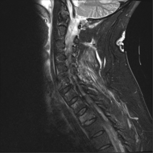 File:Blunt cerebrovascular injury (Radiopaedia 53682-59744 Sagittal T2 fat sat 5).png