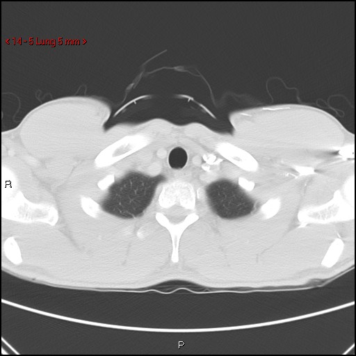 Blunt chest trauma - pulmonary interstitial emphysema and pneumomediastinum (Radiopaedia 20666-20552 Axial lung window 5).jpg