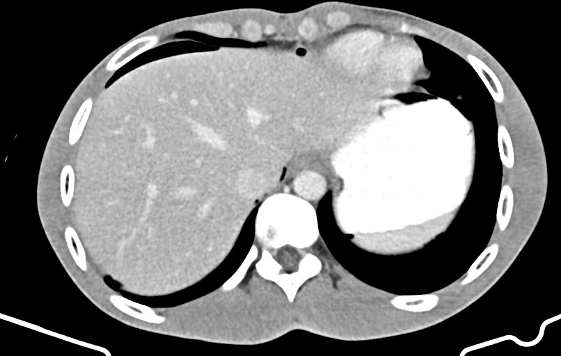 Blunt injury to the small bowel (Radiopaedia 74953-85987 A 6).jpg