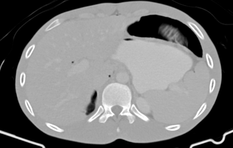 Blunt injury to the small bowel (Radiopaedia 74953-85987 Axial Wide 13).jpg