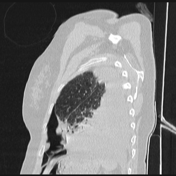 Boerhaave syndrome (Radiopaedia 45644-49799 Sagittal lung window 72).jpg