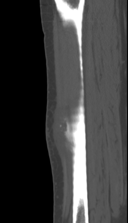Bone metastasis - tibia (Radiopaedia 57665-64609 Sagittal bone window 112).jpg