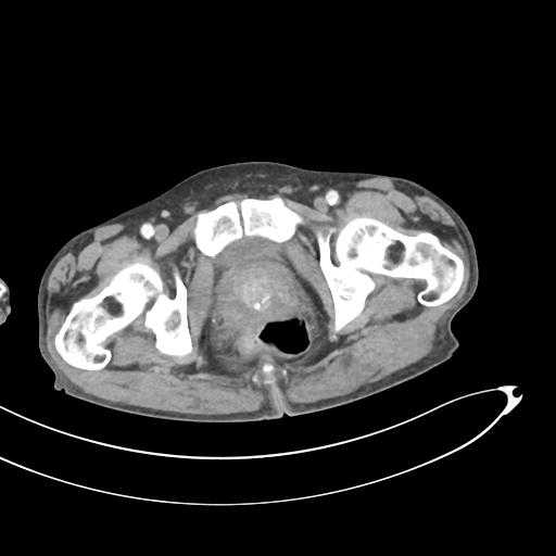 Bone metastasis from squamous cell carcinoma (Radiopaedia 30133-30730 B 78).jpg
