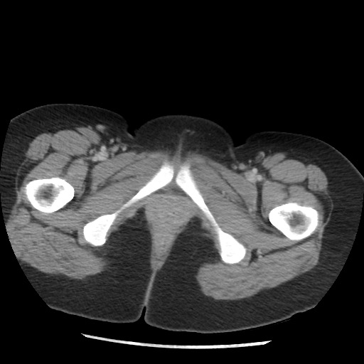 File:Borderline mucinous tumor (ovary) (Radiopaedia 78228-90808 A 143).jpg