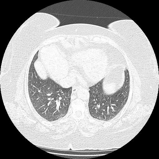 Bovine aortic arch - right internal mammary vein drains into the superior vena cava (Radiopaedia 63296-71875 Axial lung window 116).jpg