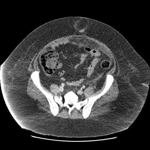 Bowel and splenic infarcts in acute lymphocytic leukemia (Radiopaedia 61055-68915 A 98).jpg
