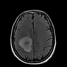 File:Brain abscess complicated by intraventricular rupture and ventriculitis (Radiopaedia 82434-96571 Axial FLAIR 16).jpg