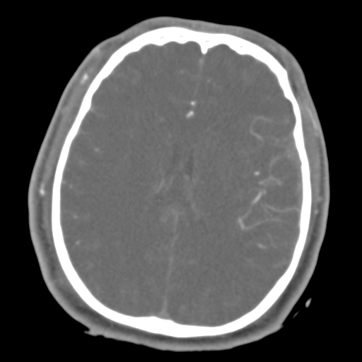 Brain contusions, internal carotid artery dissection and base of skull fracture (Radiopaedia 34089-35339 D 22).png