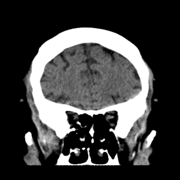 Brain cortical laminar necrosis (Radiopaedia 25822-25971 C 15).jpg