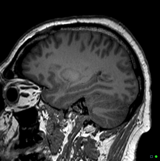 Brain death on MRI and CT angiography (Radiopaedia 42560-45689 Sagittal T1 55).jpg