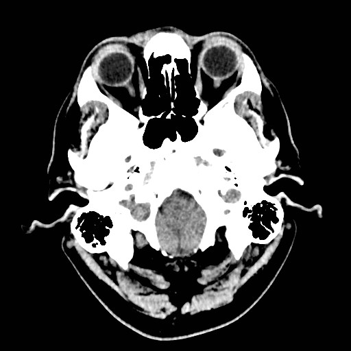 File:Brain metastases from lung cancer (Radiopaedia 83839-99027 Axial non-contrast 4).jpg