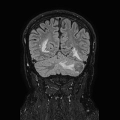 Brain metastases from lung cancer (Radiopaedia 83839-99028 Coronal FLAIR 62).jpg