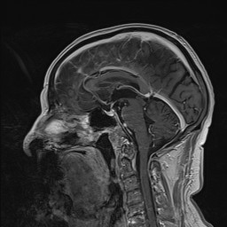 Brain metastasis (Radiopaedia 42617-45761 Sagittal T1 C+ 50).jpg